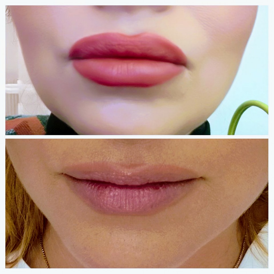 Lippen aufspritzen mit Hyaluronsäure